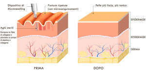 microneedling-1-1000x486